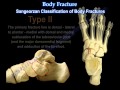 Navicular Fractures - Everything You Need To Know - Dr. Nabil Ebraheim