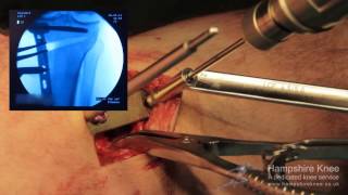 HTO - (High Tibial Osteotomy) Hampshire Knee