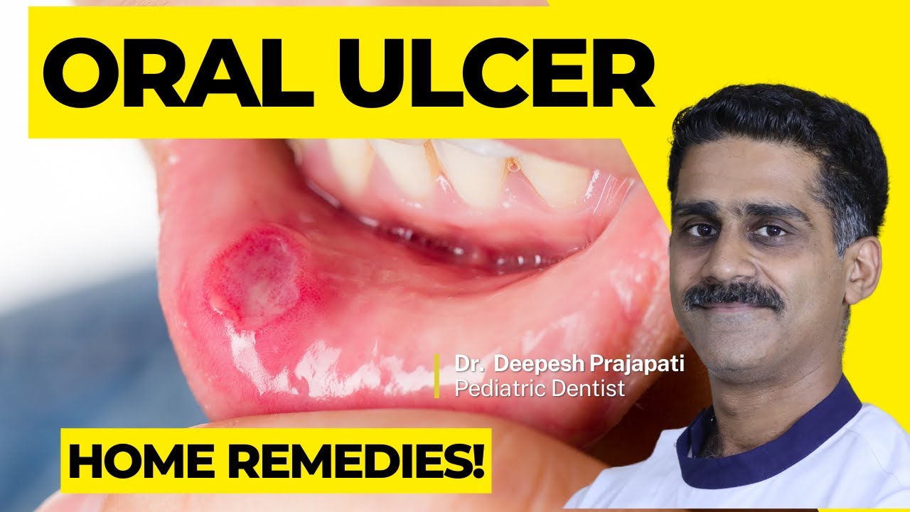 Understanding Oral Ulcers: Causes, Symptoms, And Treatment Options ...