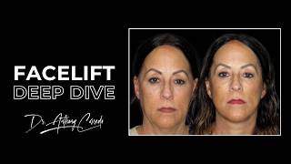 Facelift Transformation | Sagging Mid-Face, Jawline & Neck Fully Restored | Dr. Anthony Corrado