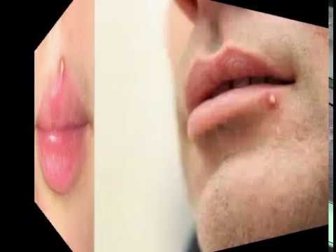Home Remedies to Get Rid of Lip Pimples | Remove Lip Acne in 3 Days Home Remedies to Get Rid of Lip Pimples | Remove Lip Acne in 3 Days