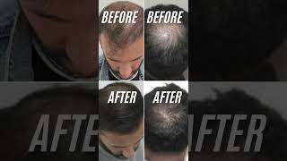 Ganjapan ka ilaj by Dr. Grewal 8708282208 | Easy treatment of hair | #shorts  #viralreels #trending