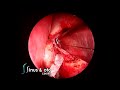 endoscopic dcr