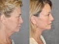 Beverly Hills Mini Lift Facelift & Lip Lift Local Anesthesia Wide Awake by Best Facelift Surgeon