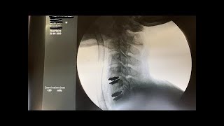 V13 人工颈椎间盘 手术日记 - 【Cervical Disc Replacement】半年一个星期后