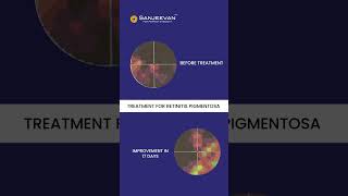 Before - After report of a patient undergoing Retinitis Pigmentosa treatment at Sanjeevan