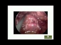 SS11 Flexible Endoscopy II: S058 PURE NATURAL ORIFICE TRANSRECTAL APPROACH FOR ONCOLOGIC RESECTION