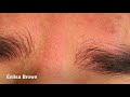 Blackhead Extractions On The Forehead/ Christian Part 1