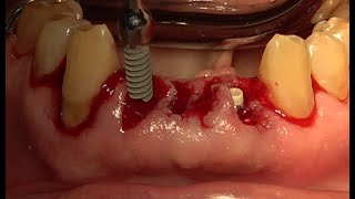 Immediate implantation with Gap filling