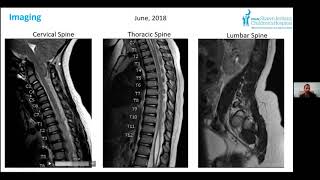 02 Tethered Cord Diagnosis and Treatment