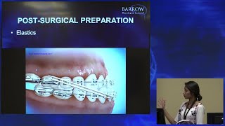 Role of Braces Before & After Jaw Surgery