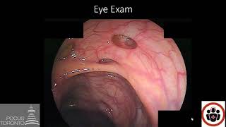 POCUS Cases 3: Idiopathic Intracranial Hypertension