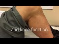 Total Knee Arthroplasty Valgus Deformity