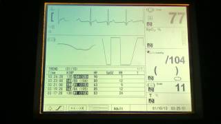 Monitoring using NELLCOR NPB-3000 ECG/NIBP with sound [LONG] [HD 1080p]