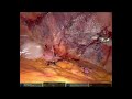 thin peritoneal flap during robotic tapp right abdominal incisional hernia repair