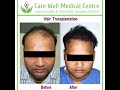 Hair Transplant Results in Delhi After 6 months | Care Well Medical Centre