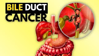 BIle Duct Cancer (Cholangiocarcinoma), Causes, Signs and Symptoms, Diagnosis and Treatment.