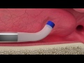 Aera Procedure Animation