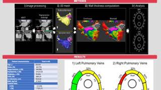 SwissCardio - Left atrial wall thickness evaluation during atrial fibrillation ReDo procedures