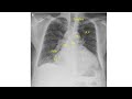 cardiomegaly on cxr