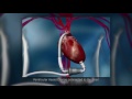 Wellspan Heart & Vascular Physician Video