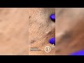 removing ingrown hair compilation body care compilation 👣