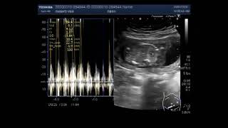 Anencephaly with a pregnancy of about 16 weeks.