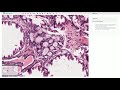 Collagenous Spherulosis - Breast Histopathology