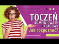 Toczeń Rumieniowaty Układowy 👉 Trudne Objawy ❤️ Jak Wykryć Toczeń | Medycyna360