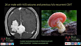 Meningioma vs hemangiopericytoma differentiating point(DP) series