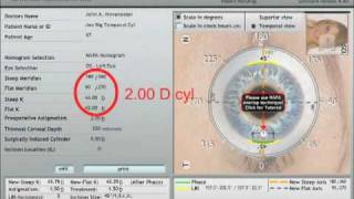 Astigmatism Correction - Cataract Surgery - Part 2