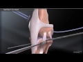 TightRope® CCL Repair