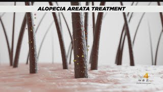 FDA approves first treatment for alopecia