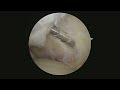 Minimally Invasive Ankle Surgery: Arthroscopic Resection of Anterior Impingement Bone Spurs