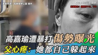 女兒遭暴打傷勢曝光！高嘉瑜父心疼嘆：她躲起來不讓我們看｜三立新聞網 SETN.com