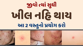 જીવો ત્યાં સુધી ખીલ નહિ થાય આ 2 વસ્તુનો પ્રયોગ કરો || 1 ||