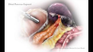 Lateral Approach to Laparoscopic Distal Pancreatectomy