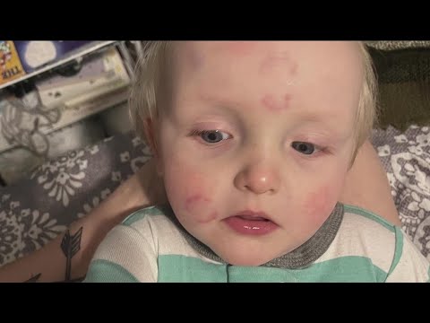 Daycare Under Investigation After Mom Picked Up Son Covered In Bites ...