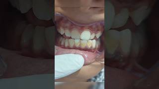 Tooth Cleaning 🦷👍🔥 #shorts #toothcleaning #scaling #shortsfeed #dental #short#dental #ytshorts