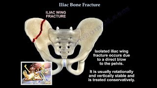 Iliac Bone Fracture - Everything You Need To Know - Dr. Nabil Ebraheim