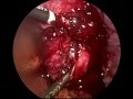 Endometriotic Cystectomy