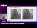 Clinical outcomes of ALLEGRA TAVI system in aortic valve disease patients - PCR Valves e-Course 2020