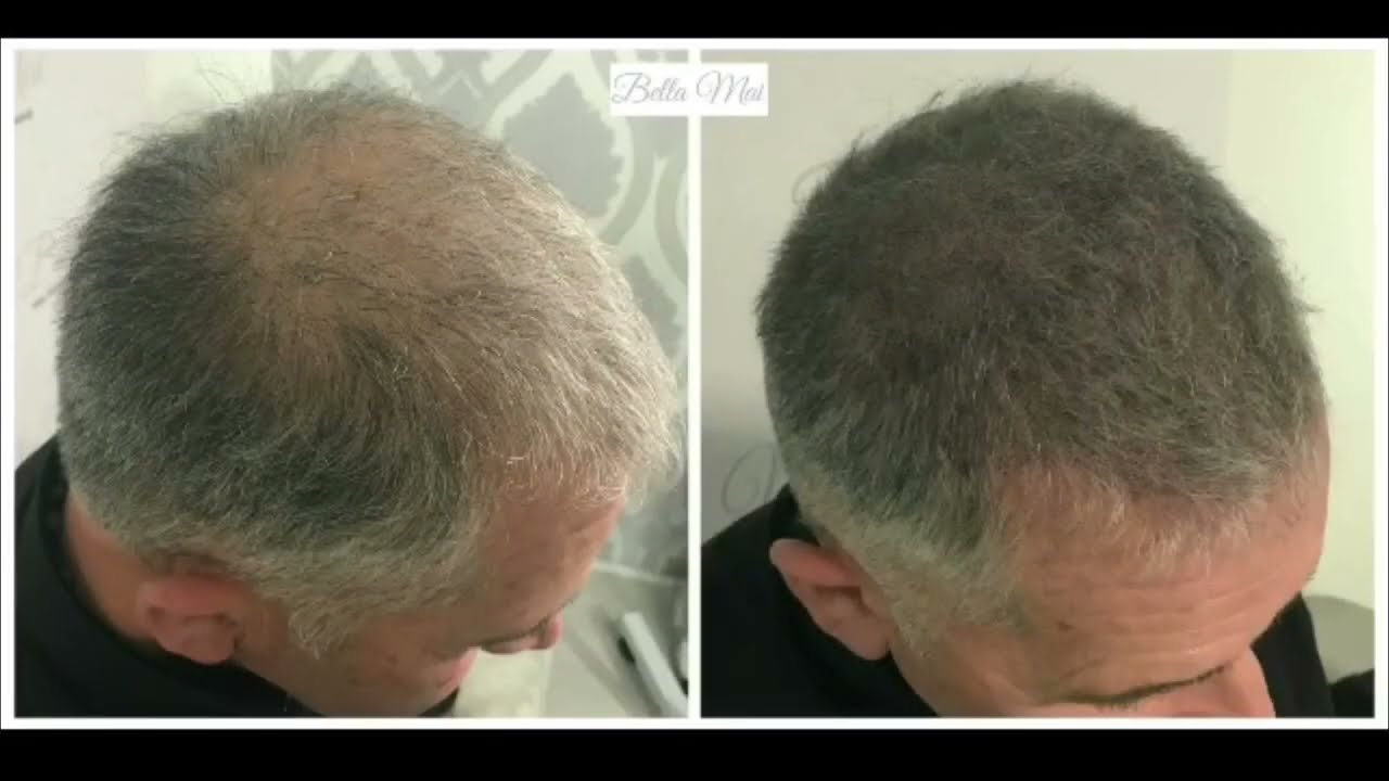 рџ ћ Scalp Micropigmentation рџ ћ Before And After Youtube