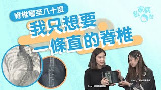 兩美少女脊椎側彎被嘲似龜 重拾自信: 身體是我自己的｜脊椎側彎 脊柱側彎 脊椎側彎矯正 脊柱側彎手術 脊柱側彎運動 ｜#私家病訪｜#8杯水