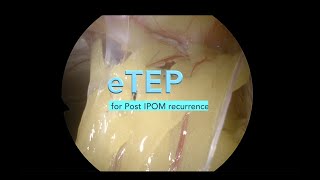 8.eTEP for IPOM recurrence