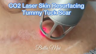 CO2 Laser Skin Resurfacing Tummy Tuck Scar