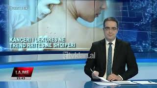 Tv Klan - Kanceri i lëkurës në trend rritës në Shqipëri | Lajme News