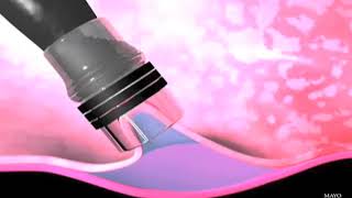 Endoscopic mucosal resection