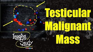 Testicular Malignant Mass || Ultrasound || Case 355