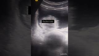 Urinary bladder mass! Ultrasound kub! #youtubeshorts #123radiology #123 ultrasonography#ultrasound